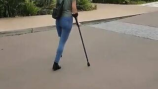 amputee