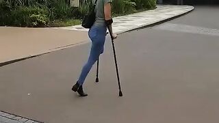 amputee